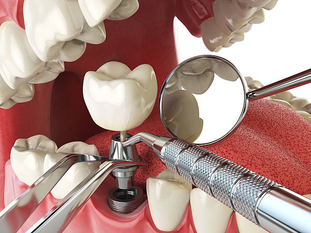 Best Emergency Tooth Extraction in Fulton, NY